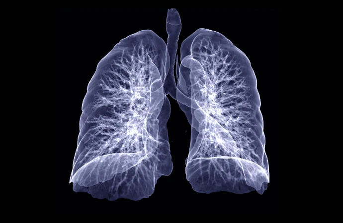 How to Better Manage Subsolid Lung Nodules?