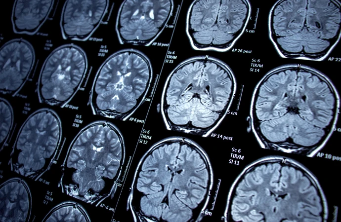 Enhancing Brain Metastases Visualisation With Dynamic Contrast-Enhanced MRI