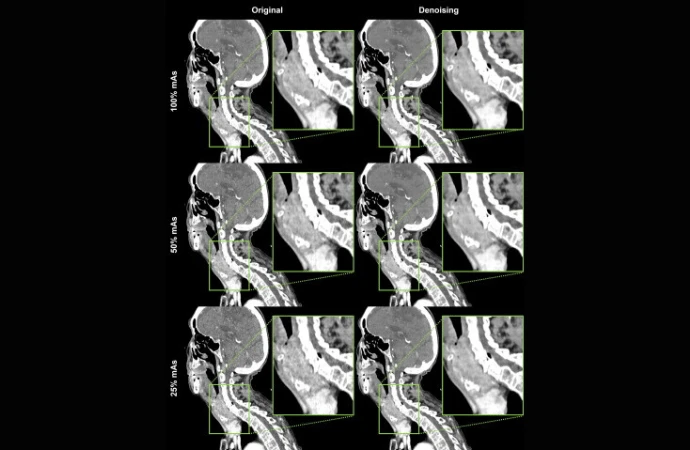 AI Denoising in Neck CT Imaging Enhances Diagnostic Accuracy