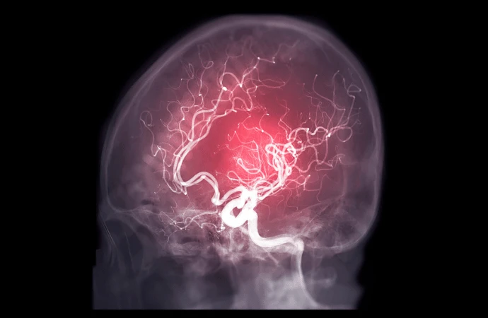 Predictive Radiological Grading in Aneurysmal Subarachnoid Hemorrhage 