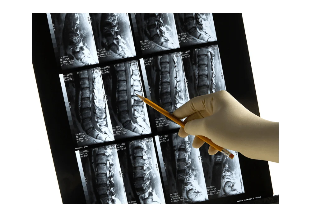 Sacroiliac Joint Imaging for Spondyloarthritis: ASAS Recommendations