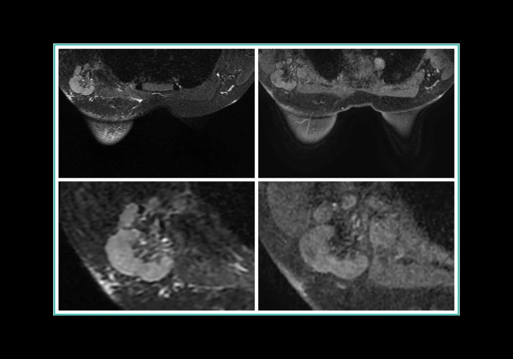 Node-RADS for Predicting Lymph Node Involvement in Breast Cancer