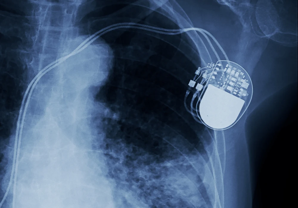 MRI in Patients with Abandoned Cardiovascular Implantable Devices