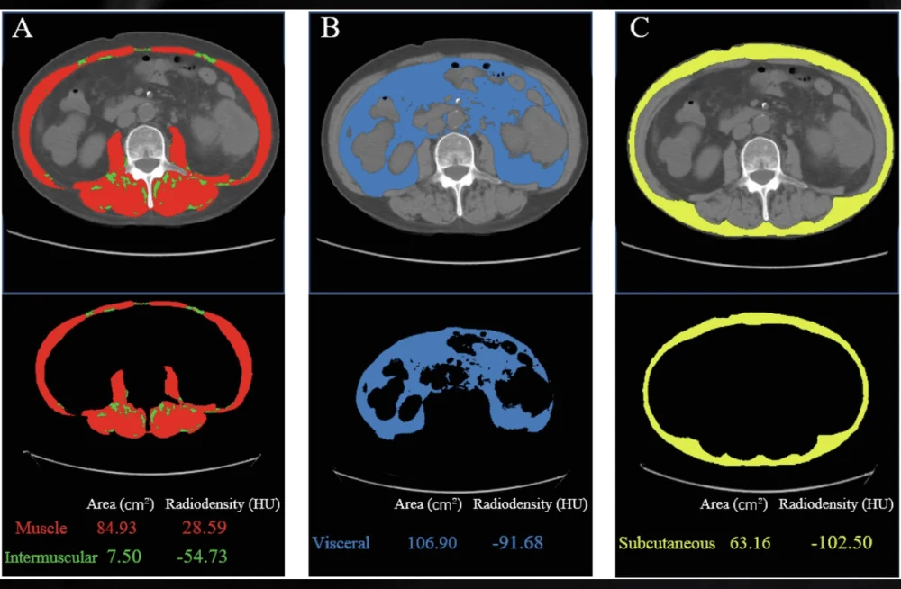 New Prognostic Scoring for Colorectal Cancer