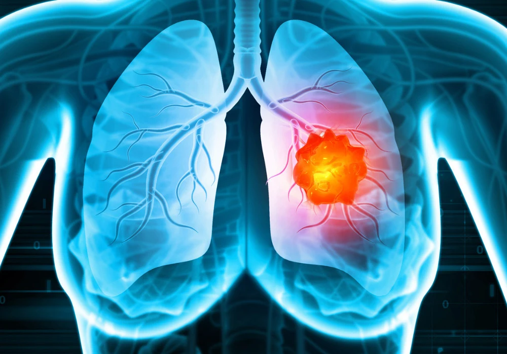 Advancing Treatment Precision: IMRT in Locally Advanced Lung Cancer