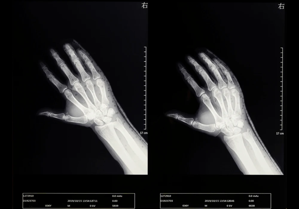 Exploring Radiopalmar Ganglion Cysts With Wrist MRI Studies