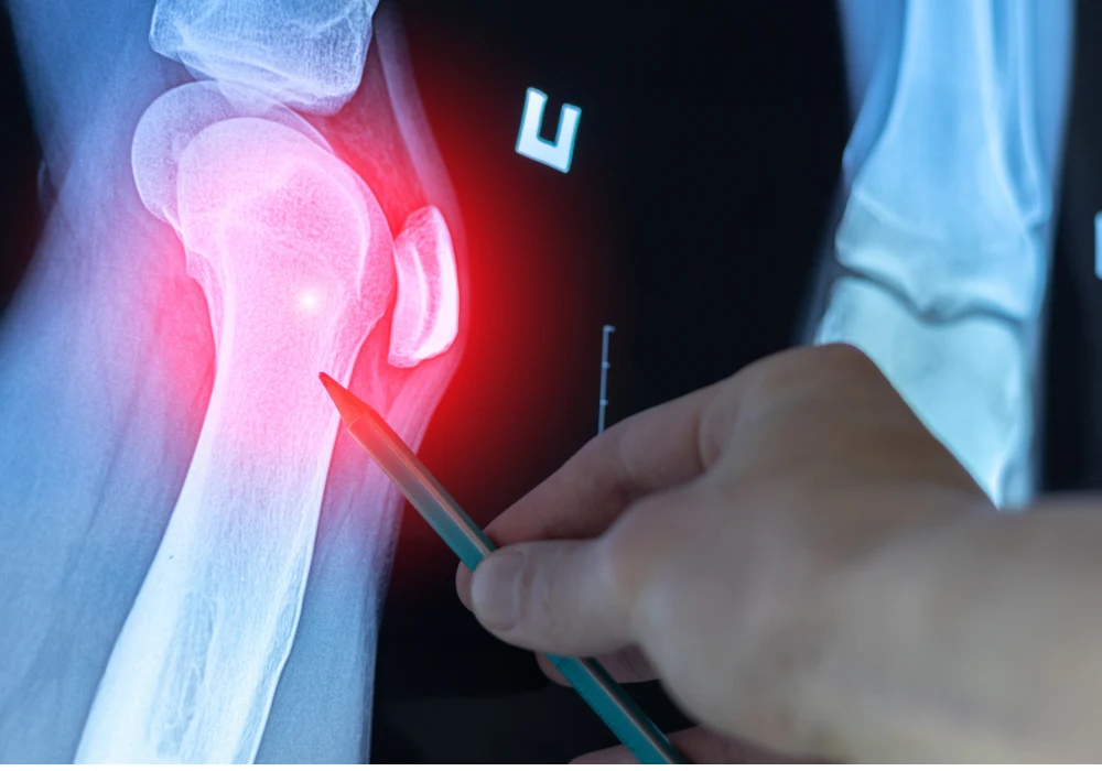 AI Enhances Precision and Agreement in Knee Osteoarthritis Diagnosis