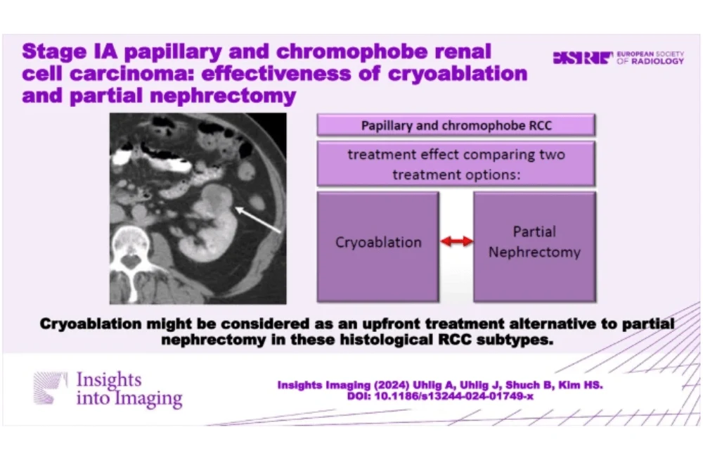 Cryoablation Versus Partial Nephrectomy in Treating Renal Cell Carcinomas