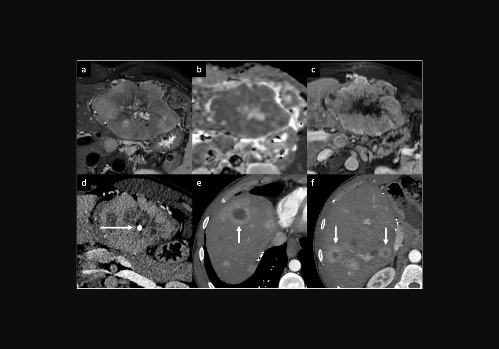 Understanding Peripheral Arterial Enhancement of Focal Liver Lesions