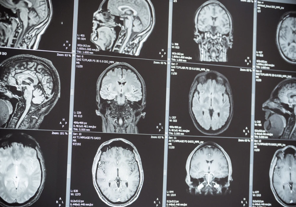 Unveiling Brain Flow: Advanced MRI for Neurological Diagnosis