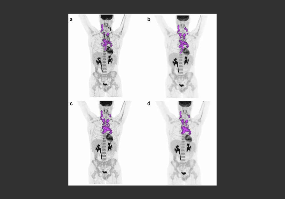 [18F]FDG-PET/CT for Hodgkin Lymphoma Staging &amp; Therapy Monitoring