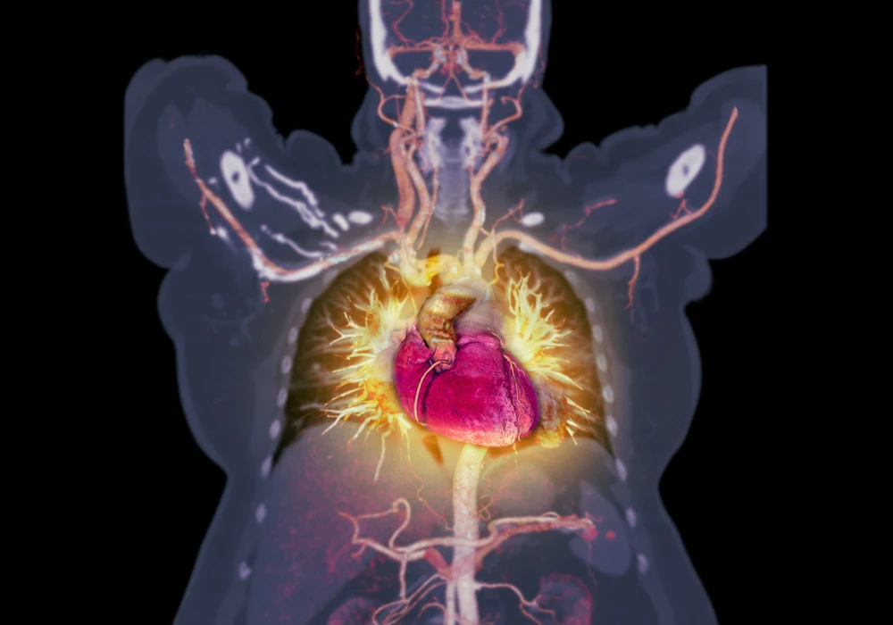 Clinical Significance of Differential Ventricular Stroke Volumes: the MESA Study