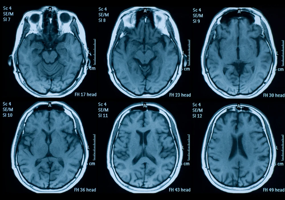 Denoising AI Model for Accelerated Parallel Brain MRI