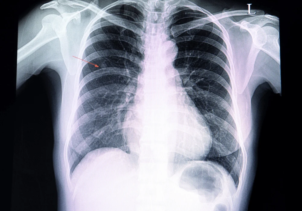 Pulmonary Nodule Risk Estimation With Deep Learning and Uncertainty Analysis