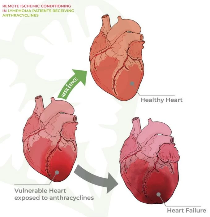 RESILIENCE: Remote Ischaemic Conditioning for Prevention of Anthracycline Cardiotoxicity