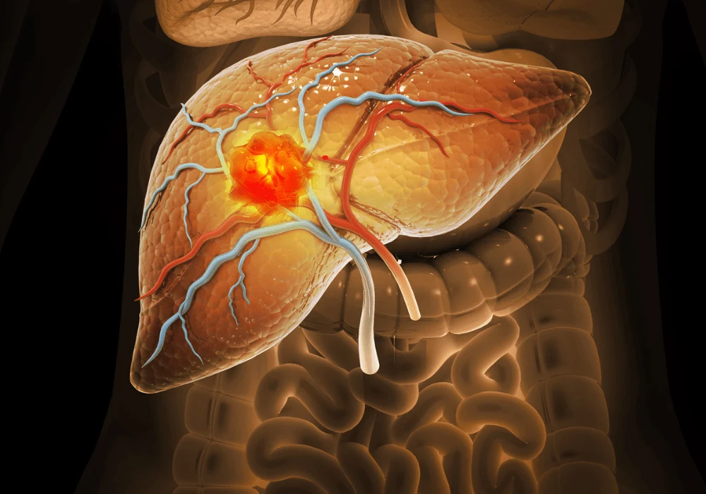 Advancing Hepatocellular Carcinoma Imaging