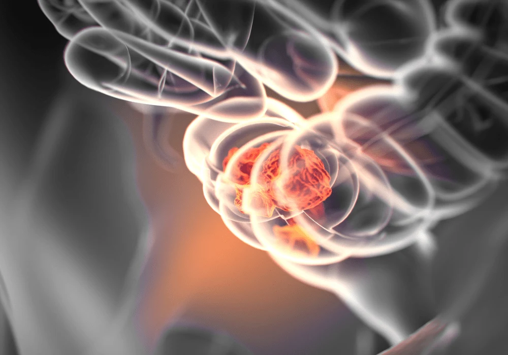 How to Manage Pelvic Recurrence of Rectal Cancer with MRI
