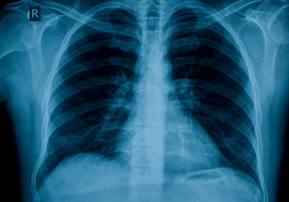 AI in Radiology: The Role of GPT-4 in Chest Radiograph Evaluation