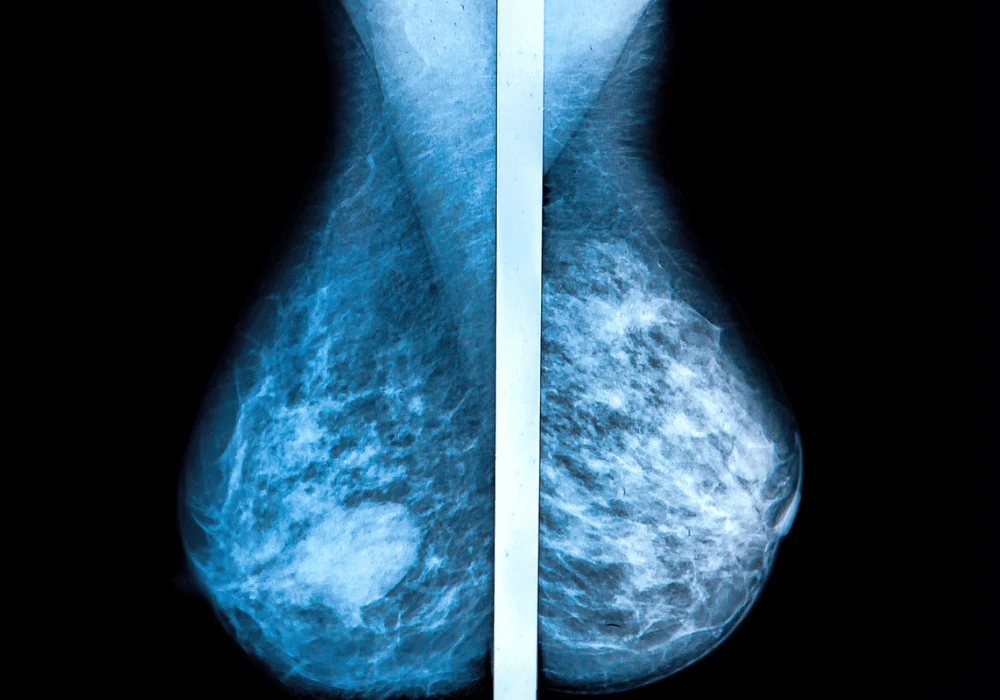 Non-Detected Cancers in One-View Breast Screening