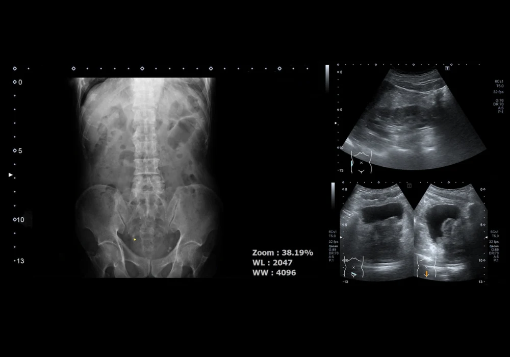 Super-Resolution Ultrasound for Prostate Cancer Imaging
