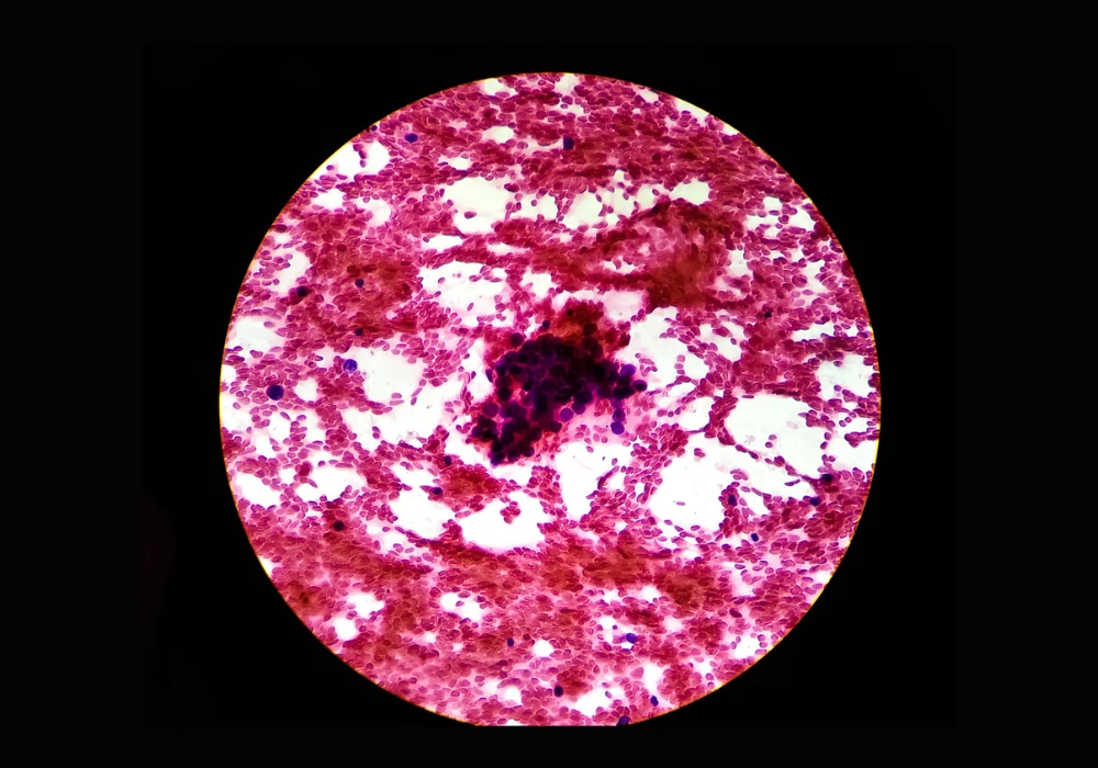 Microscopic view of liver tissue from CT-guided FNA, stained with hematoxylin and eosin