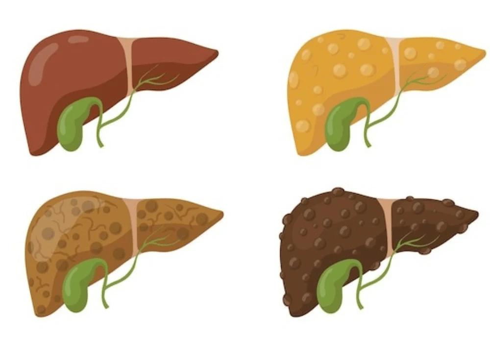 Human liver disease stages illustrated for medical education and healthcare awareness&nbsp;