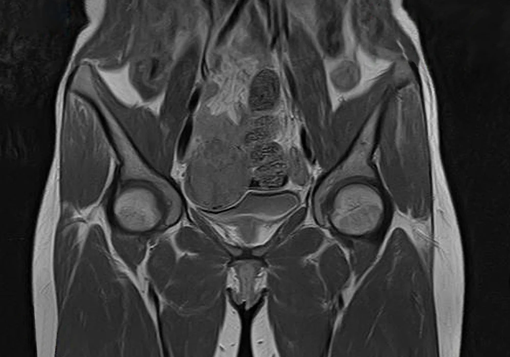 Coronal pelvic MRI scan displaying hip joints and pelvic anatomy, often used to evaluate musculoskeletal conditions, tumours or pelvic organ abnormalities.&nbsp;