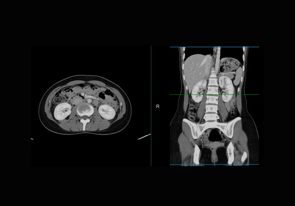 CT scan of the abdomen showing kidneys and spine in axial and coronal views with contrast enhancement.