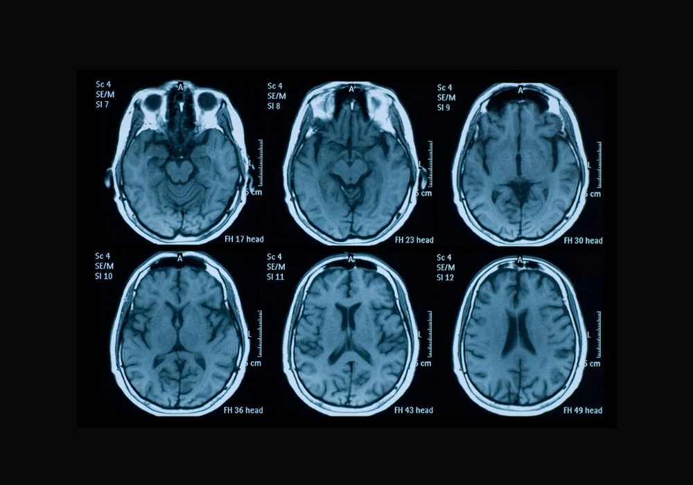 Brain MRI scan series showing axial cross-sections of the human head in diagnostic imaging.&nbsp;
