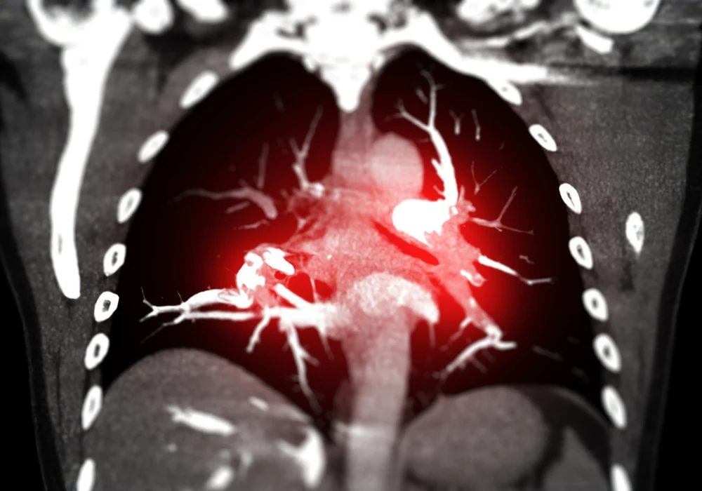 Contrast-enhanced CT scan of lungs highlighting pulmonary embolism in the pulmonary arteries