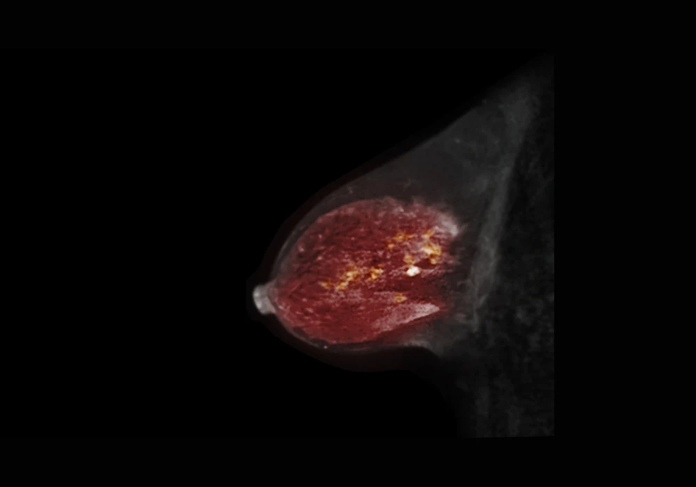 Colour-enhanced breast MRI scan showing internal tissue and vascular structure for tumour detection and breast health evaluation&nbsp;