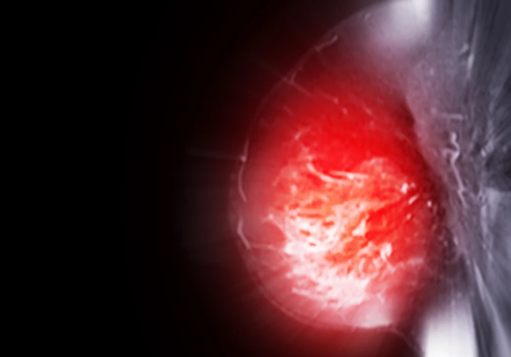 Breast MRI scan showing enhanced contrast area, indicating potential tumour for diagnostic evaluation.&nbsp;