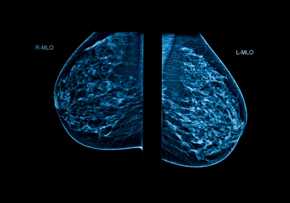 Mammogram image showing right and left breast in mediolateral oblique (MLO) view for breast cancer screening.&nbsp;