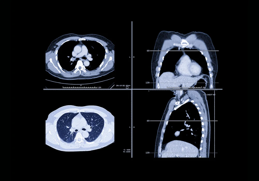 CT scan of the chest showing cross-sectional and coronal views of lungs, heart and mediastinum for diagnostic evaluation.&nbsp;