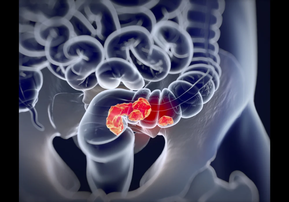 3D medical illustration showing rectal cancer in the lower colon, highlighting tumour growth and intestinal anatomy for oncology and colorectal disease education.&nbsp;