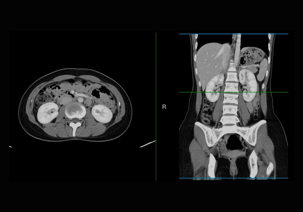 CT scan of abdomen and pelvis showing cross-sectional and coronal views for diagnostic evaluation&nbsp;