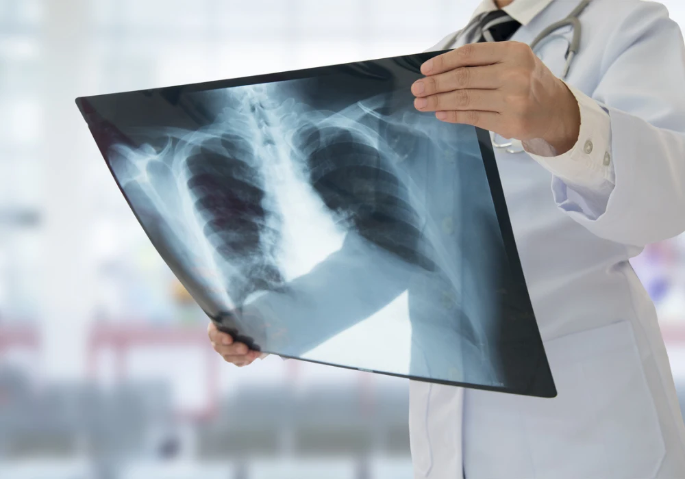  Doctor examining chest X-ray film for lung and thoracic diagnostics in hospital setting&nbsp;