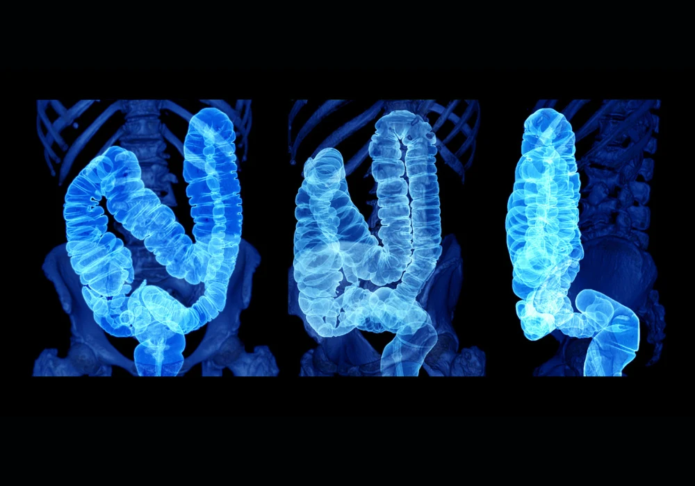 3D medical imaging of human colon for gastrointestinal diagnosis and colorectal disease screening&nbsp;