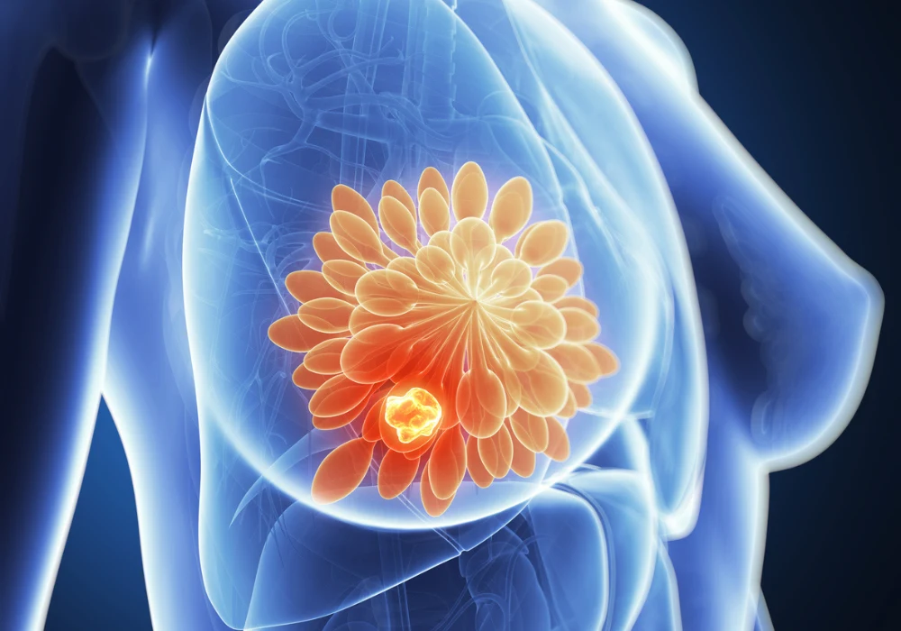 3D medical illustration of breast anatomy showing tumour for breast cancer diagnosis and research&nbsp;