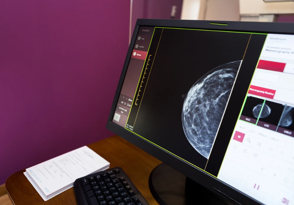 Digital mammogram on computer screen showing breast tissue imaging for cancer detection