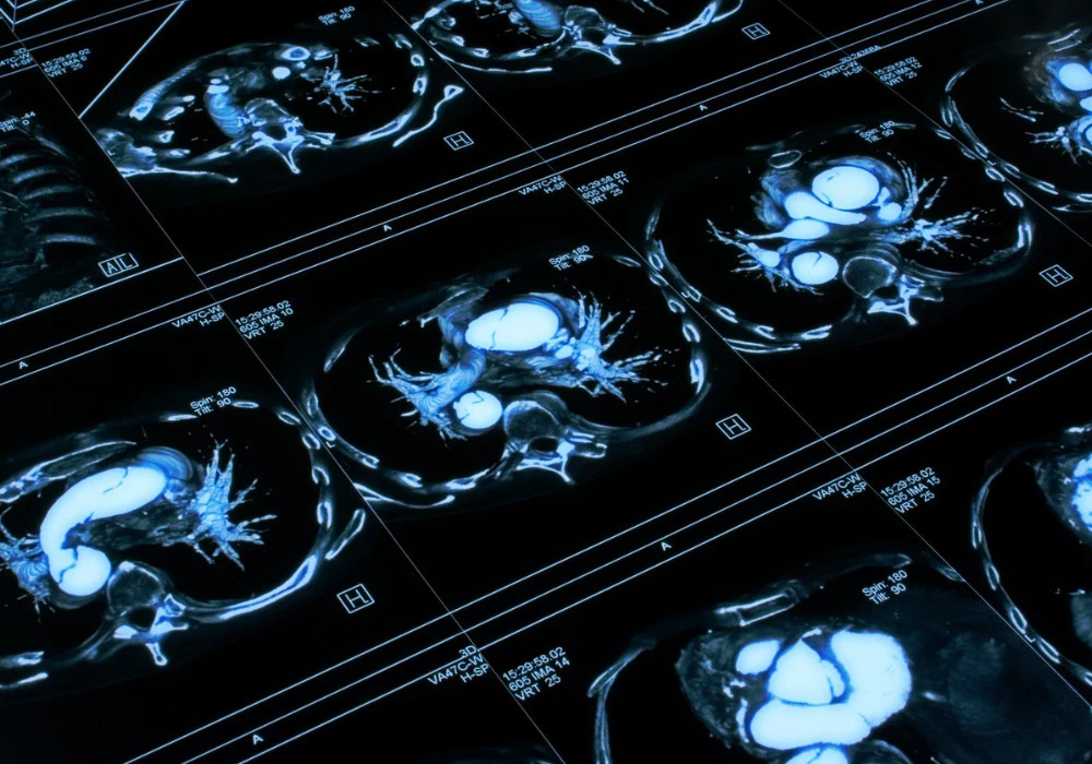 Axial chest MRI scan showing heart, lungs and major blood vessels in high contrast.&nbsp;