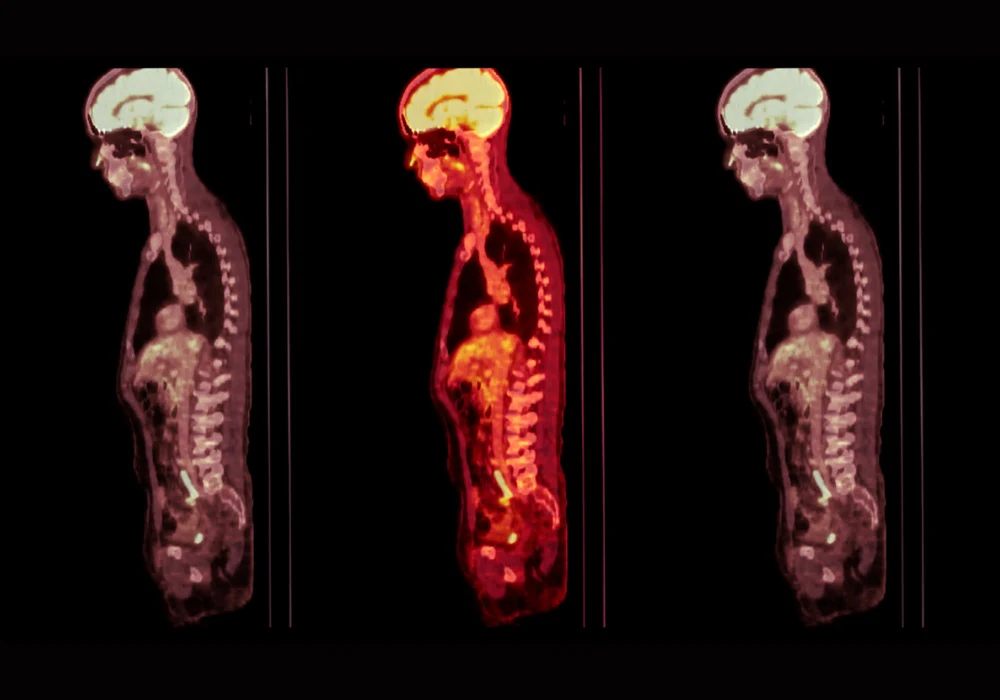 Whole-body PET-CT scan showing sagittal views for detecting abnormal metabolic activity.&nbsp;