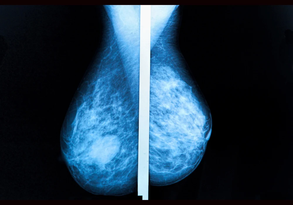 Mammogram showing breast tissue density and potential abnormality in diagnostic screening.&nbsp;