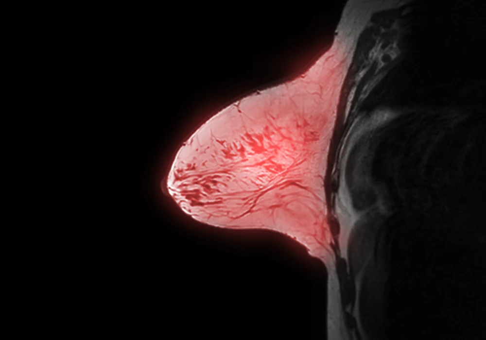 Breast MRI scan showing detailed tissue structure for cancer detection and diagnosis&nbsp;