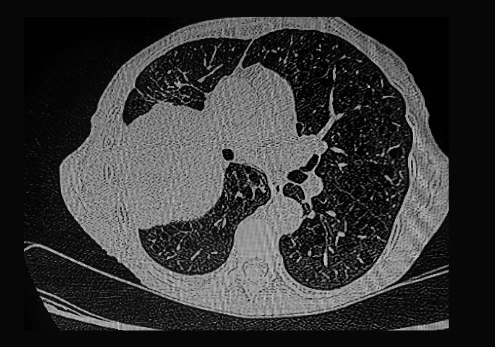 CT scan of human lungs showing cross-sectional imaging for respiratory disease diagnosis&nbsp;