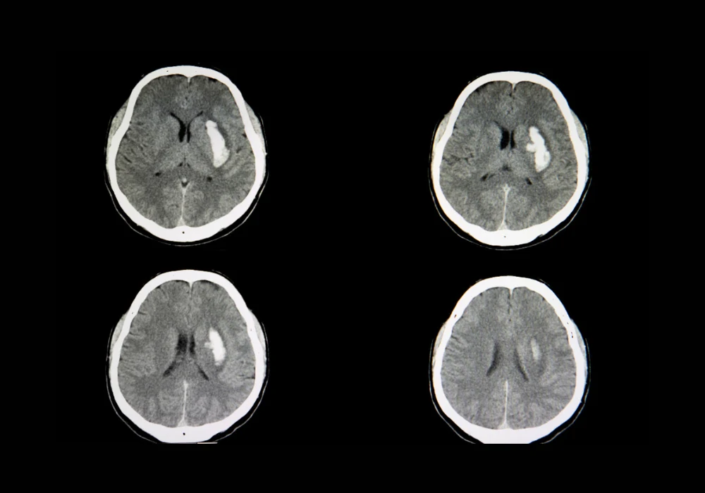CT brain scan showing intracerebral haemorrhage for stroke diagnosis and evaluation
