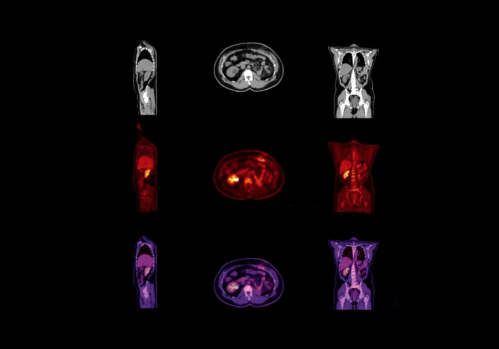 PET/CT scan images showing abdominal cross-sections with metabolic activity&nbsp;