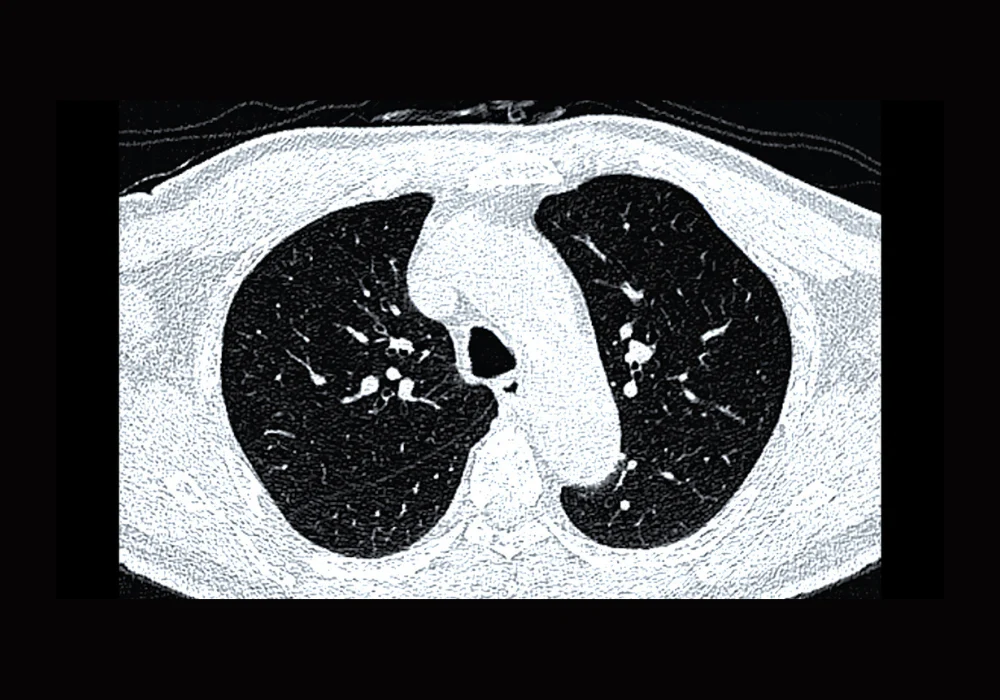 CT chest scan used to assess respiratory structures and detect lung disease&nbsp;