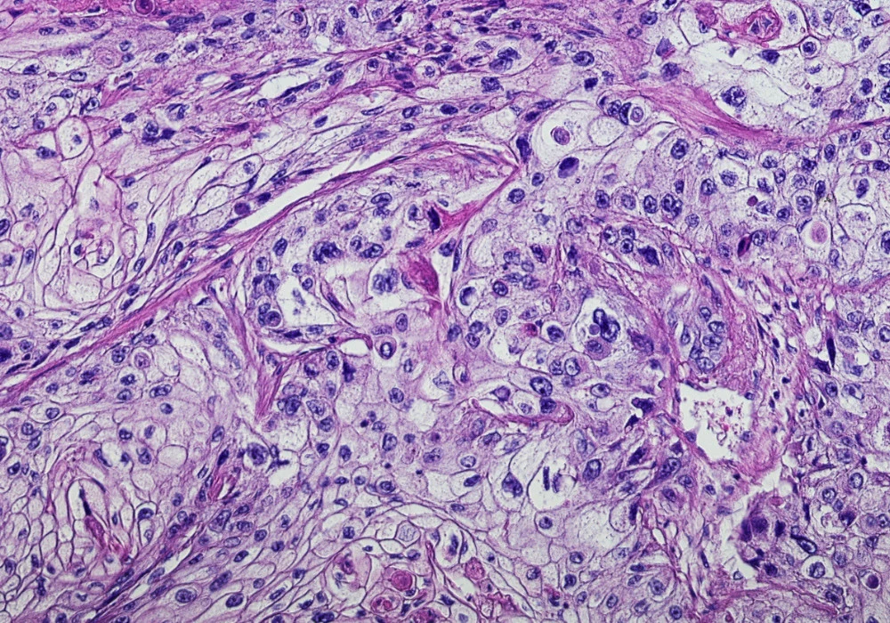 Microscopic view of carcinoma tissue stained with H&amp;E for cancer diagnosis.&nbsp;