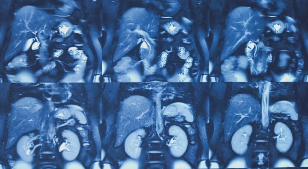 Abdominal MRI coronal series showing both kidneys and upper abdominal organs.&nbsp;